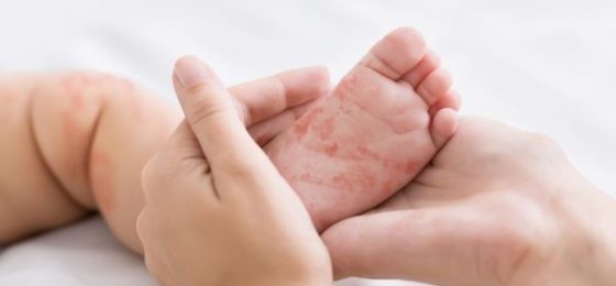 Is Measles a Real Threat or More Fear Mongering?